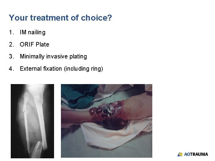 Your treatment of choice? 1. IM nailing 2. ORIF Plate 3. Minimally invasive plating