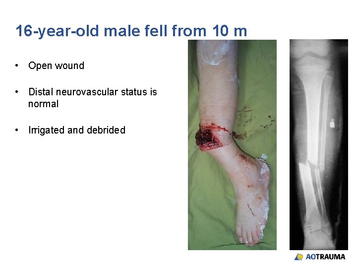 16 -year-old male fell from 10 m • Open wound • Distal neurovascular status