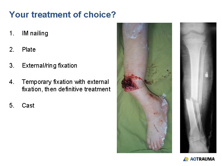 Your treatment of choice? 1. IM nailing 2. Plate 3. External/ring fixation 4. Temporary
