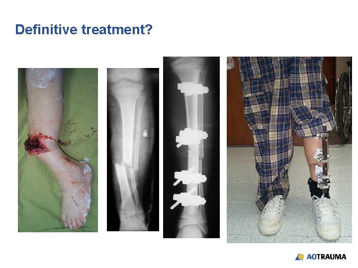 Definitive treatment? 