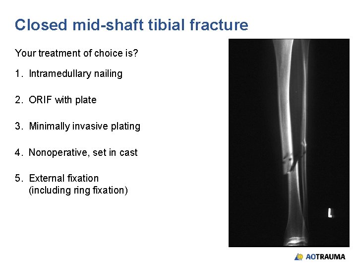 Closed mid-shaft tibial fracture Your treatment of choice is? 1. Intramedullary nailing 2. ORIF