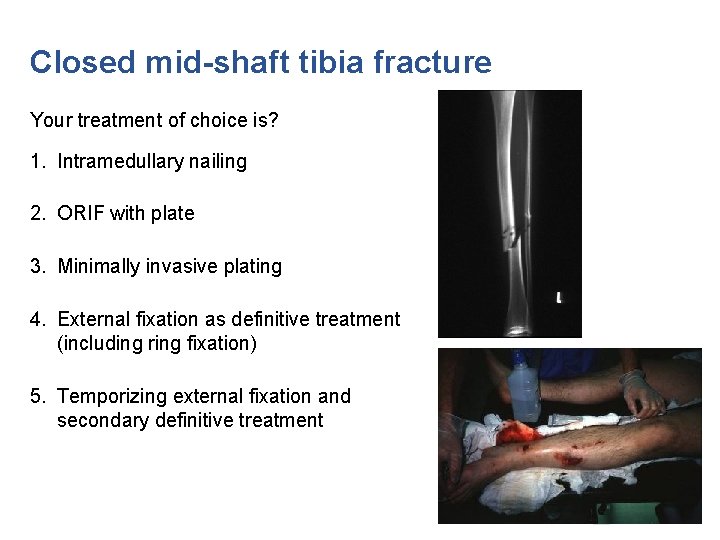 Closed mid-shaft tibia fracture Your treatment of choice is? 1. Intramedullary nailing 2. ORIF