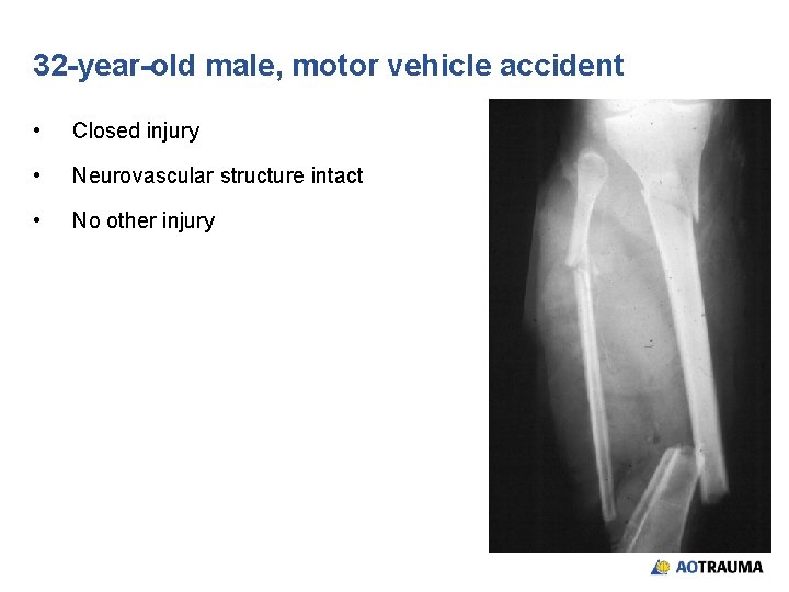 32 -year-old male, motor vehicle accident • Closed injury • Neurovascular structure intact •