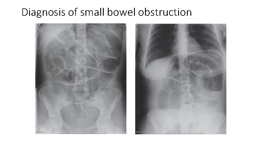 Diagnosis of small bowel obstruction 