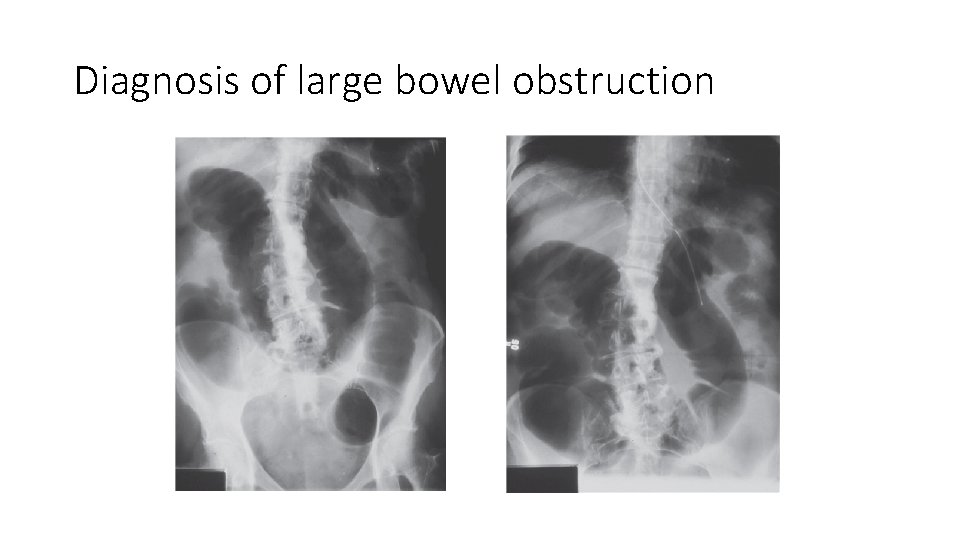 Diagnosis of large bowel obstruction 