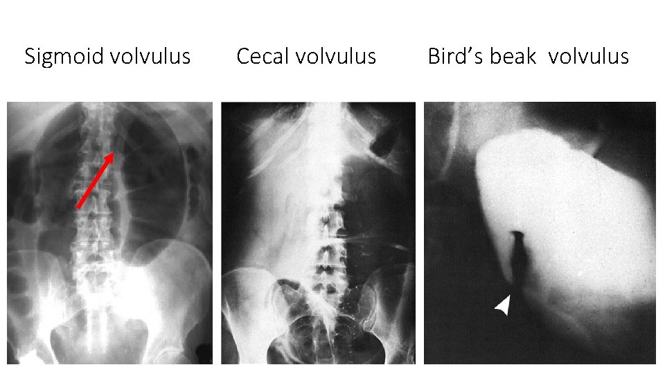 Sigmoid volvulus Cecal volvulus Bird’s beak volvulus Sigmoid volvulus Cecal volvulus Bird’s beak volvulus