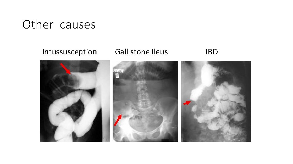 Other causes Intussusception Gall stone Ileus IBD 