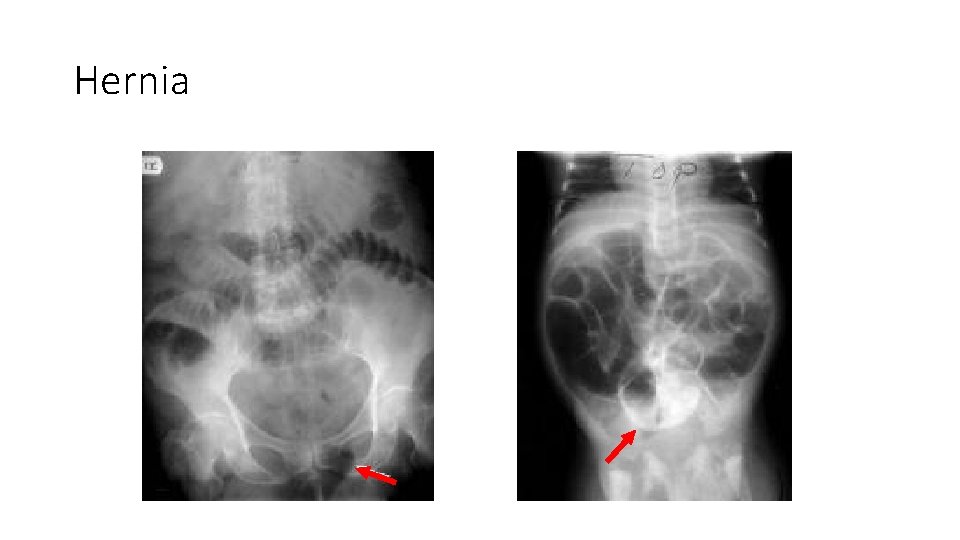 Hernia Hernia