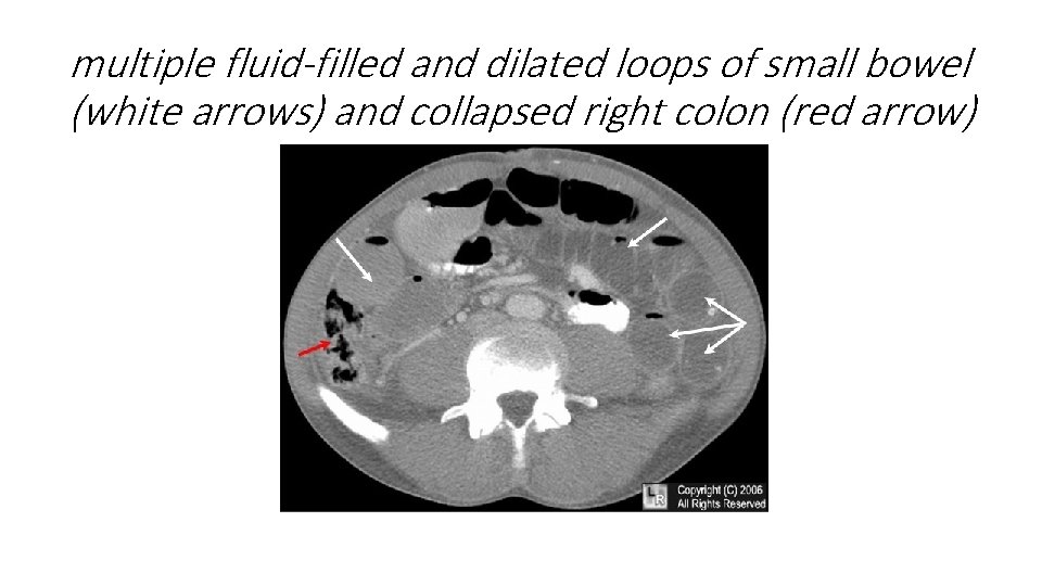 multiple fluid-filled and dilated loops of small bowel (white arrows) and collapsed right colon