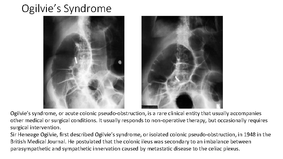 Ogilvie’s Syndrome Ogilvie’s syndrome, or acute colonic pseudo-obstruction, is a rare clinical entity that