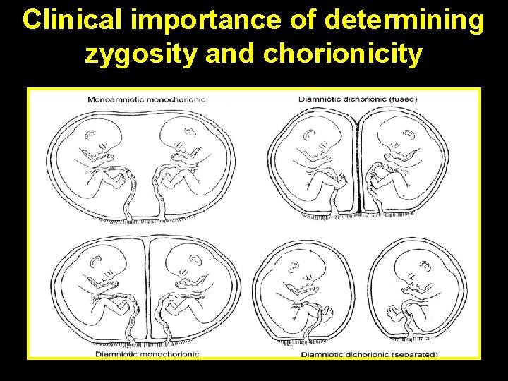 Clinical importance of determining zygosity and chorionicity 