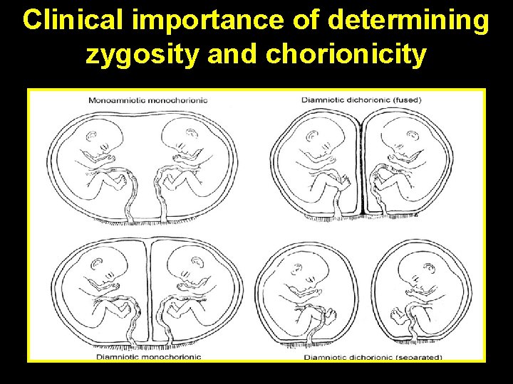 Clinical importance of determining zygosity and chorionicity Clinical importance of determining zygosity and chorionicity