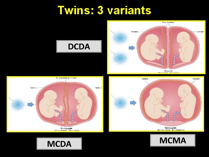 Twins: 3 variants DCDA MCMA Twins: 3 variants DCDA MCMA