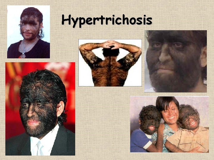 Hypertrichosis 