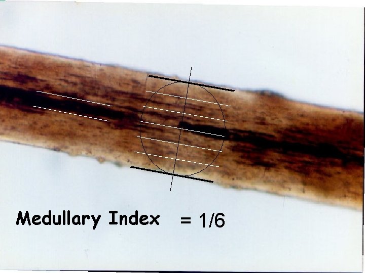 Medullary Index = 1/6 