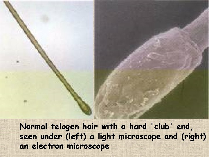 Normal telogen hair with a hard 'club' end, seen under (left) a light microscope