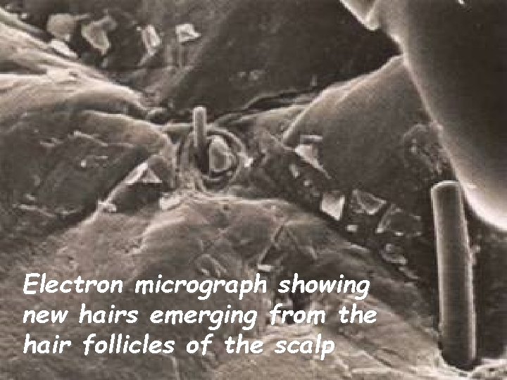 Electron micrograph showing new hairs emerging from the hair follicles of the scalp 