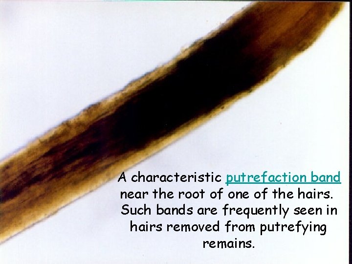 A characteristic putrefaction band near the root of one of the hairs. Such bands