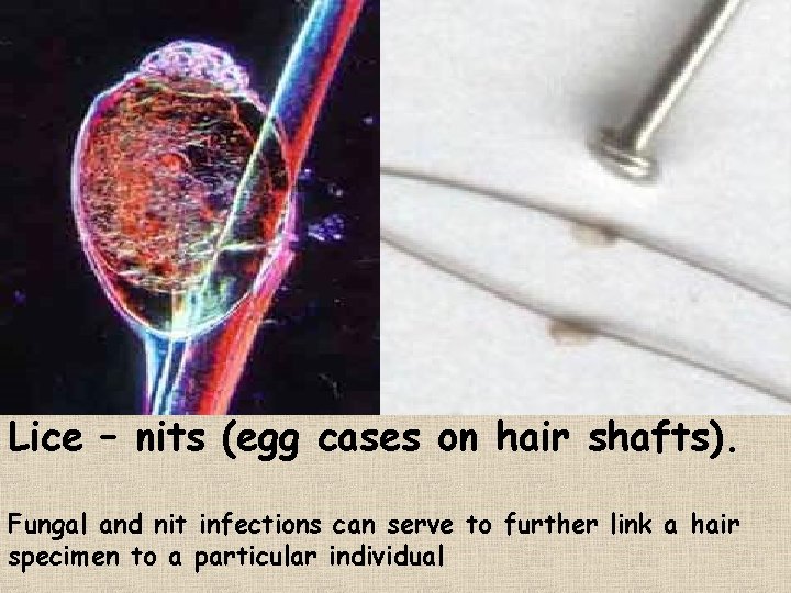 Lice – nits (egg cases on hair shafts). Fungal and nit infections can serve
