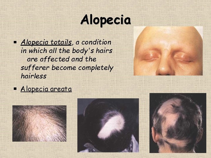 Alopecia totails, a condition in which all the body's hairs are affected and the