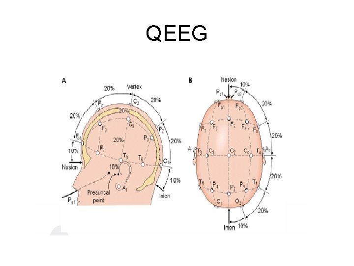 QEEG 