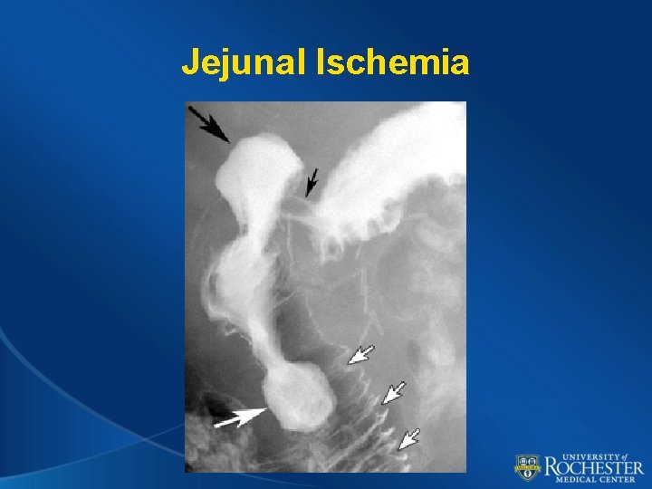 Jejunal Ischemia 