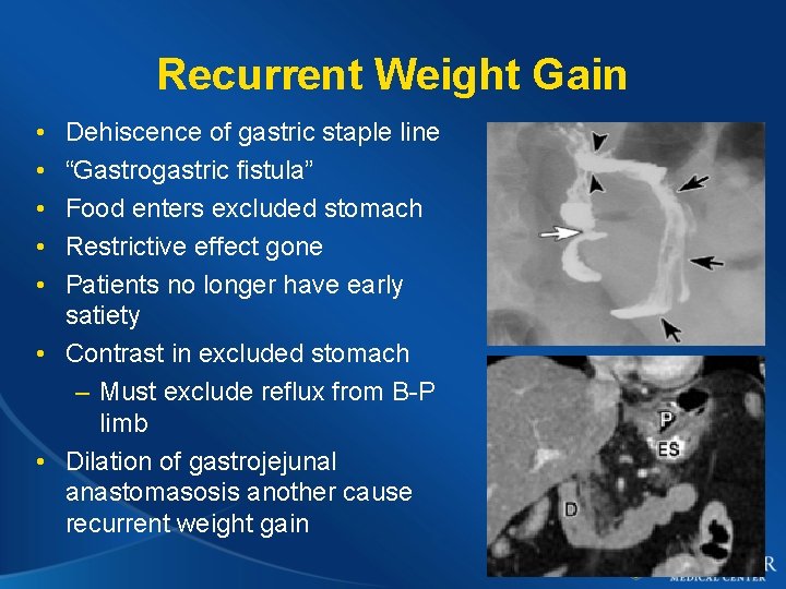 Recurrent Weight Gain • • • Dehiscence of gastric staple line “Gastrogastric fistula” Food