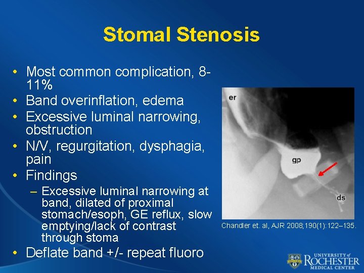 Stomal Stenosis • Most common complication, 811% • Band overinflation, edema • Excessive luminal
