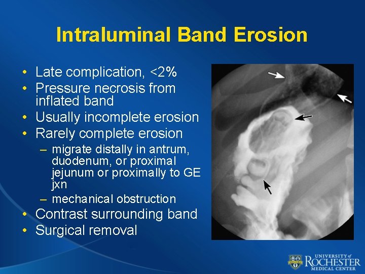 Intraluminal Band Erosion • Late complication, <2% • Pressure necrosis from inflated band •
