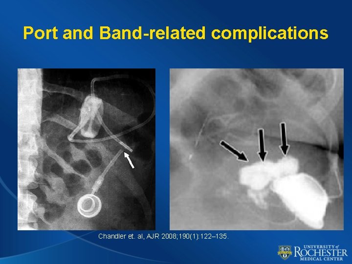 Port and Band-related complications Chandler et. al, AJR 2008; 190(1): 122– 135. 