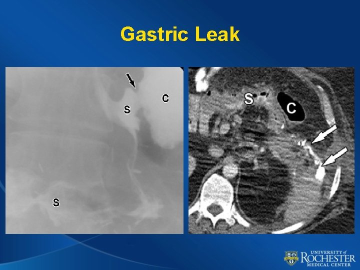 Gastric Leak 