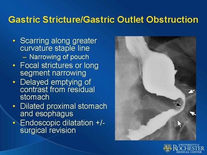 Gastric Stricture/Gastric Outlet Obstruction • Scarring along greater curvature staple line – Narrowing of