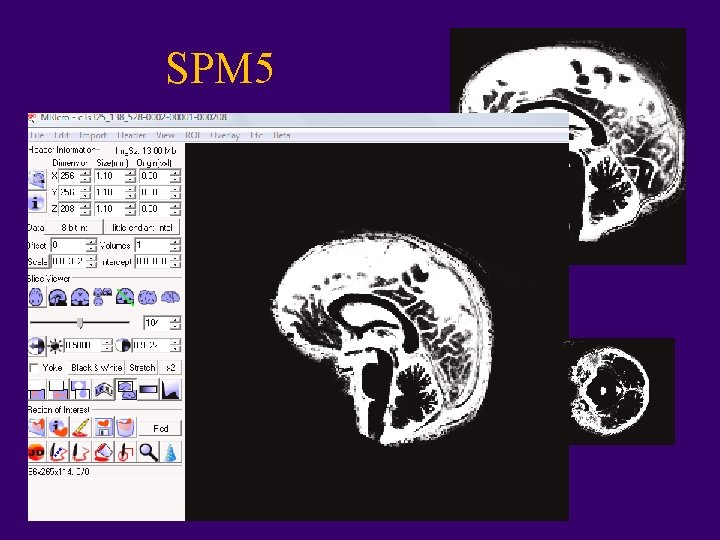 SPM 5 • Surestimation du LCS : +++ 