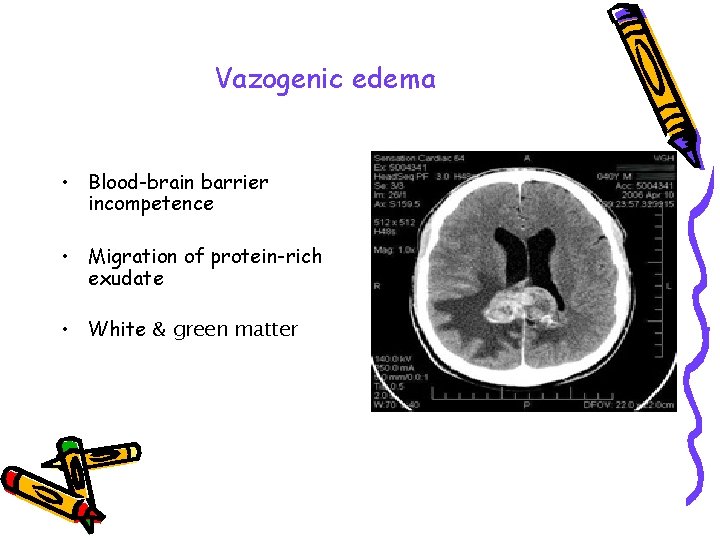 Vazogenic edema • Blood-brain barrier incompetence • Migration of protein-rich exudate • White &