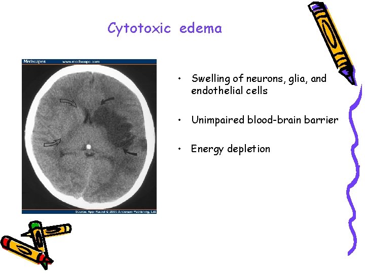 Cytotoxic edema • Swelling of neurons, glia, and endothelial cells • Unimpaired blood-brain barrier