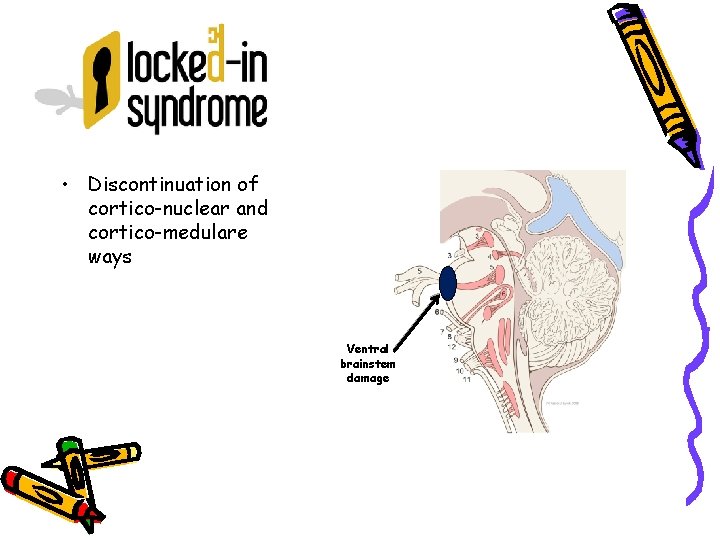  • Discontinuation of cortico-nuclear and cortico-medulare ways Ventral brainstem damage 