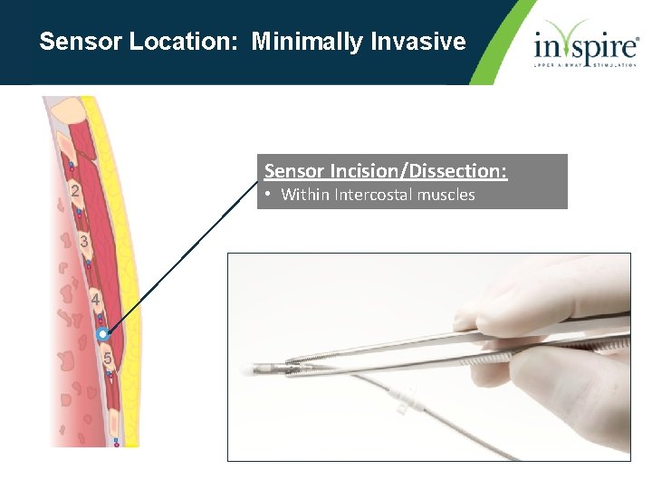 Sensor Location: Minimally Invasive Sensor Incision/Dissection: 2 • Within Intercostal muscles 3 4 5