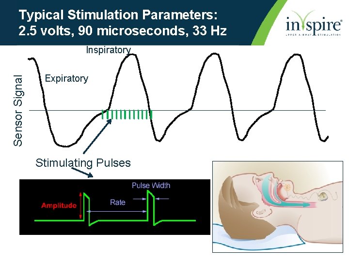 Typical Stimulation Parameters: 2. 5 volts, 90 microseconds, 33 Hz Sensor Signal Inspiratory Expiratory