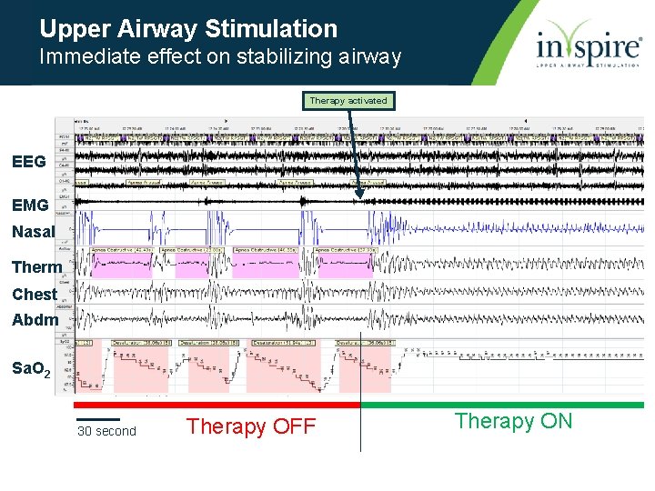 Upper Airway Stimulation Immediate effect on stabilizing airway Therapy activated EEG EMG Nasal Therm
