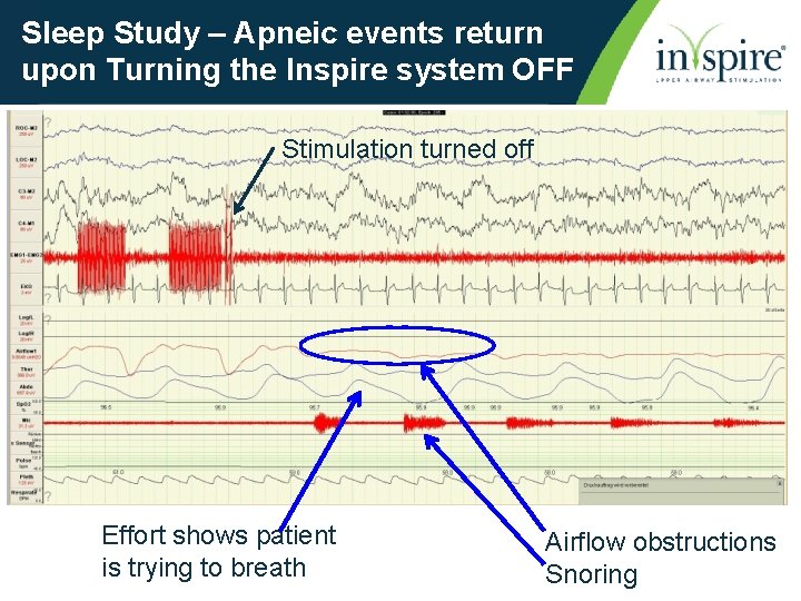 Sleep Study – Apneic events return upon Turning the Inspire system OFF Stimulation turned