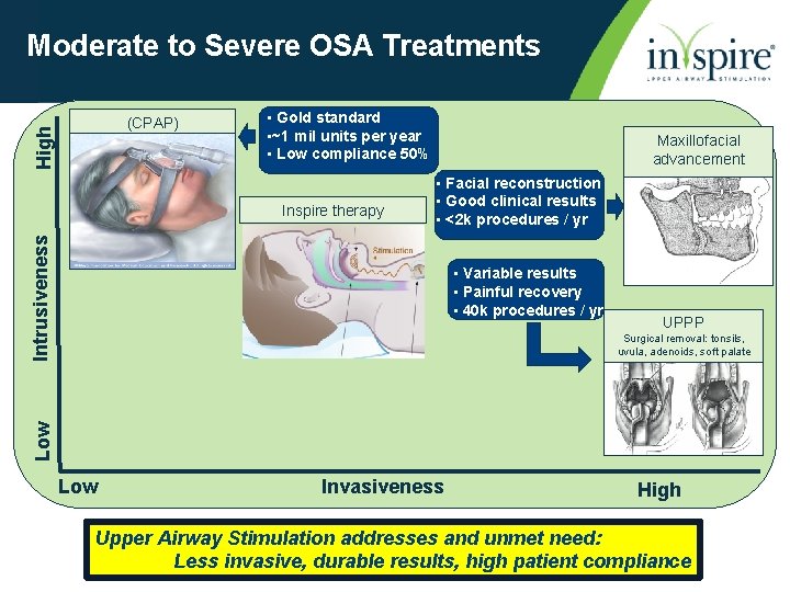 Moderate to Severe OSA Treatments High (CPAP) • Gold standard • ~1 mil units