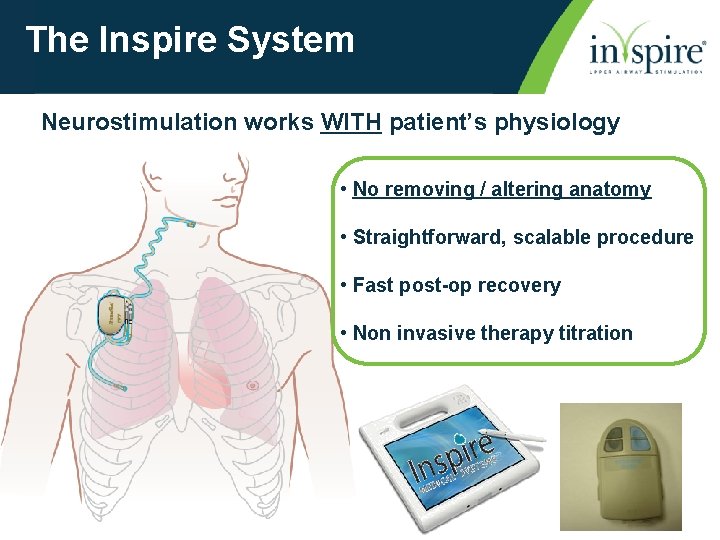 The Inspire System Neurostimulation works WITH patient’s physiology • No removing / altering anatomy
