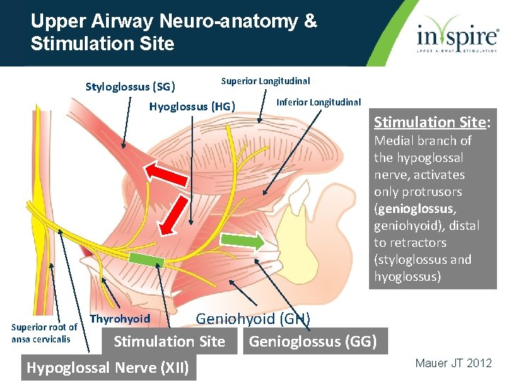 Upper Airway Neuro-anatomy & Stimulation Site Styloglossus (SG) Superior Longitudinal Hyoglossus (HG) Inferior Longitudinal