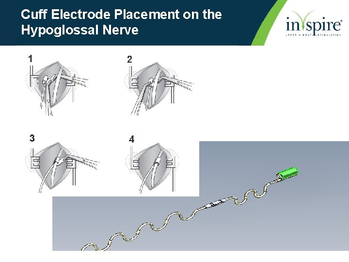 Cuff Electrode Placement on the Hypoglossal Nerve 