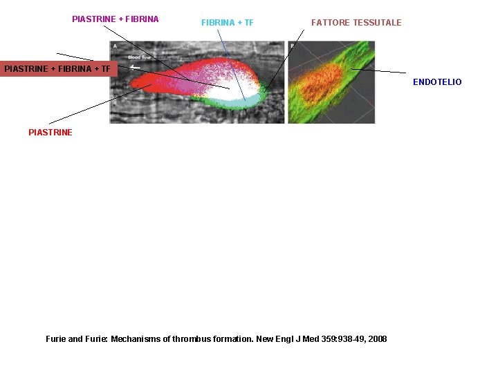 PIASTRINE + FIBRINA + TF FATTORE TESSUTALE PIASTRINE + FIBRINA + TF ENDOTELIO PIASTRINE