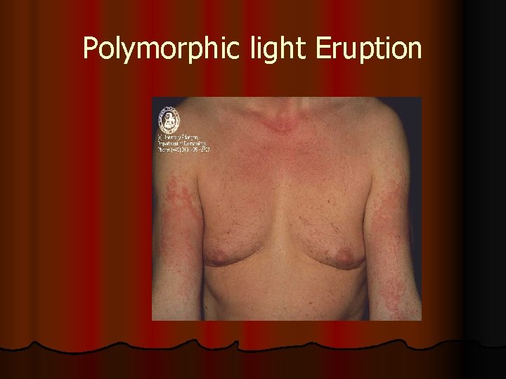 Polymorphic light Eruption 
