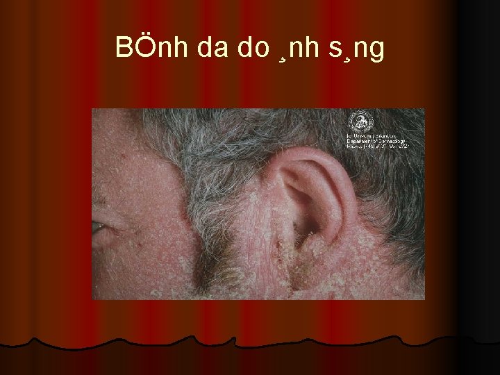 BÖnh da do ¸nh s¸ng 