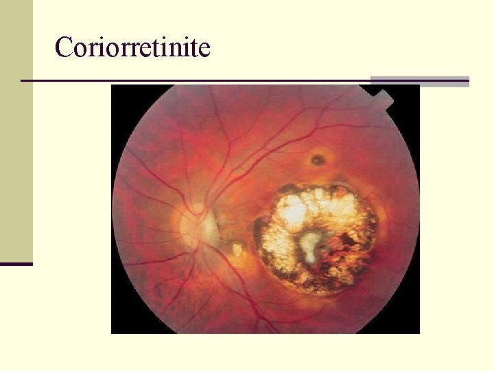 Coriorretinite 