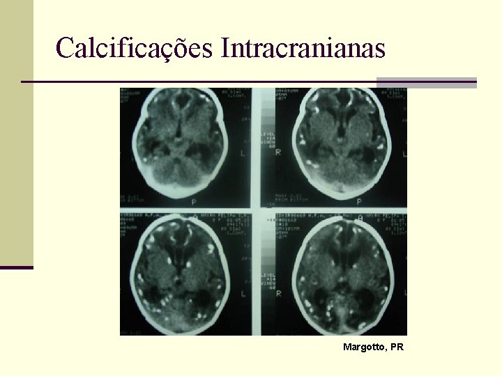 Calcificações Intracranianas Margotto, PR 