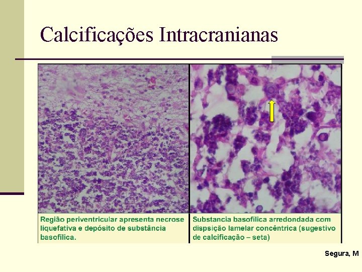 Calcificações Intracranianas Segura, M 